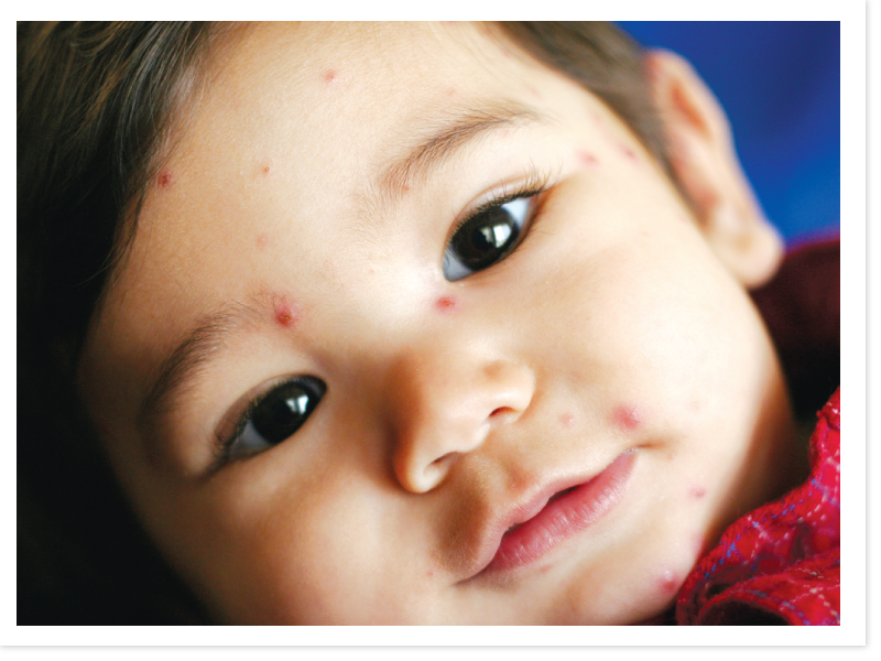 chickenpox