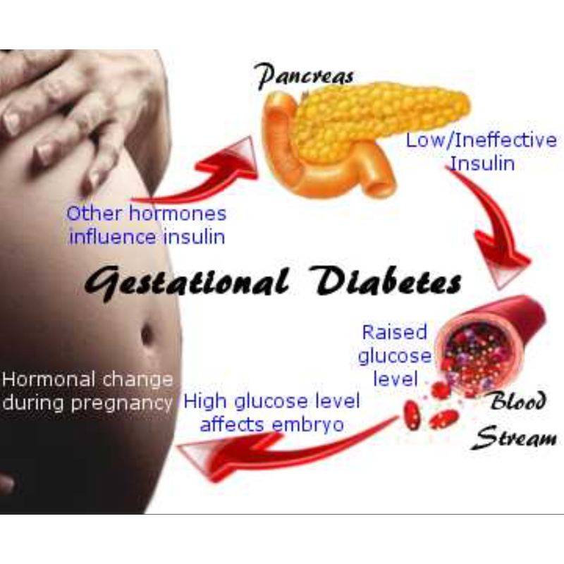 Gestational Diabetes Symptoms Reddit