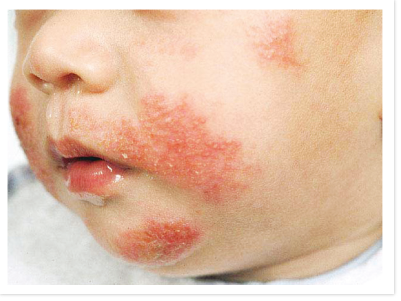 Common Baby Skin Problems Mother Baby And Kids