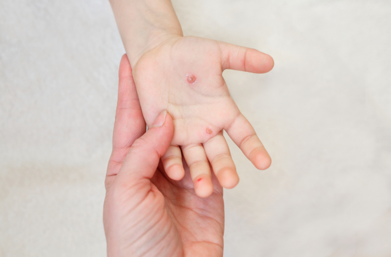 chickenpox in pregnancy