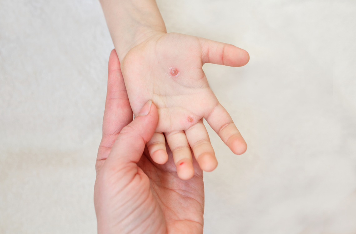 chickenpox-in-pregnancy-december-2023-motherhood-malaysia