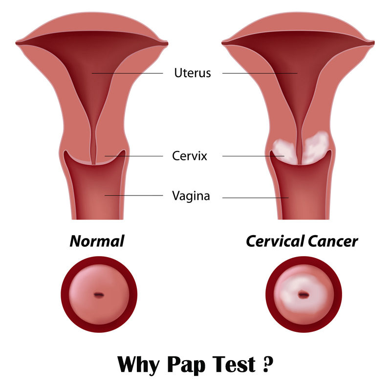 Spread cervical cancer awareness