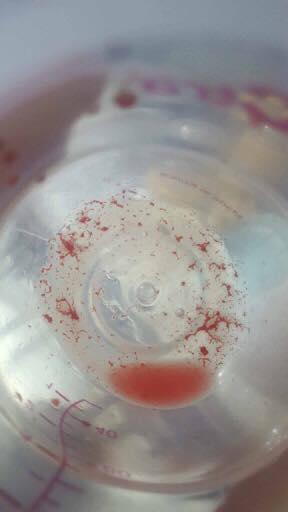 thickened blood at the bottom of a baby bottle