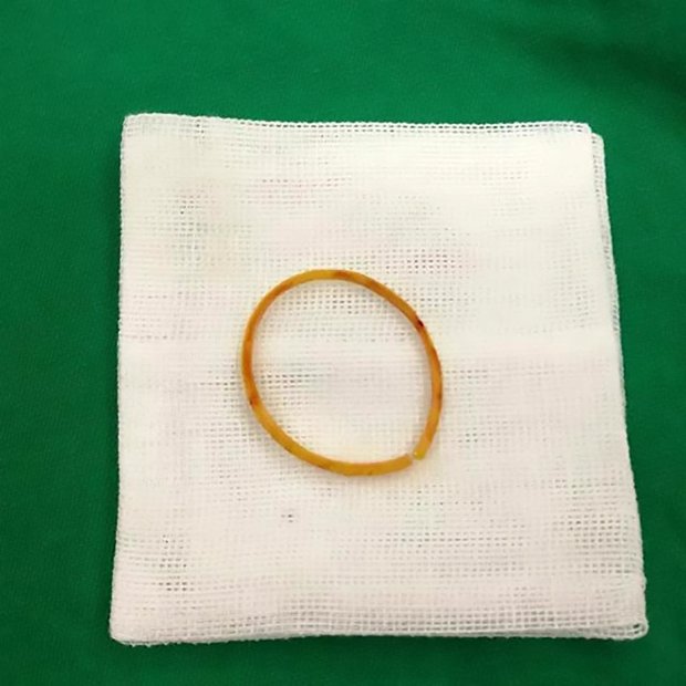 The rubber band that was inside Le Le's arm