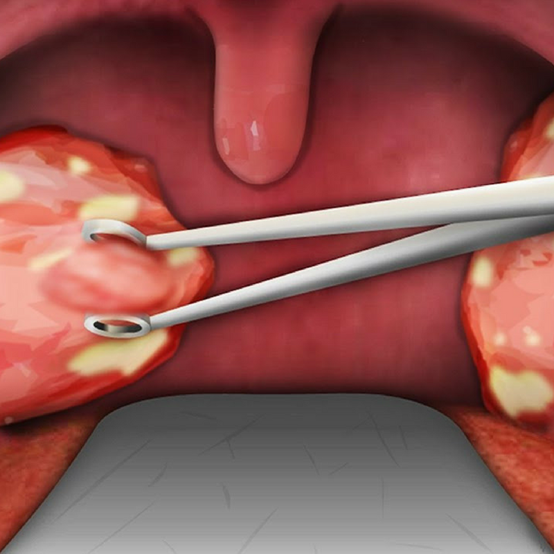 tonsils in children