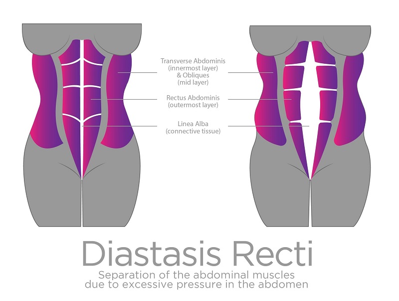 Diastasis Recti