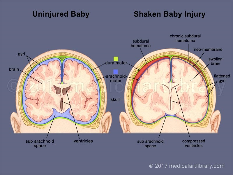 shaken-baby-syndrome