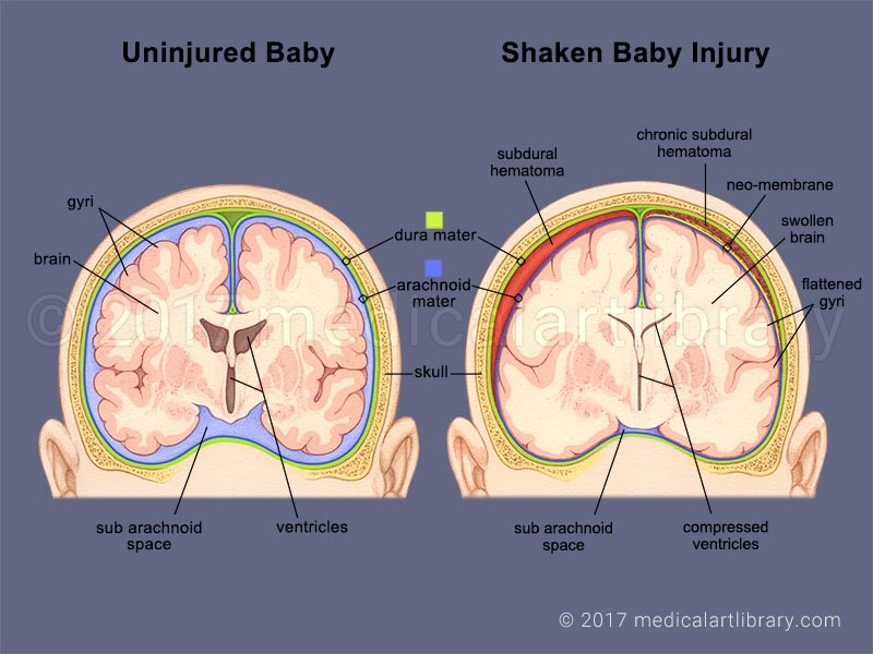 shaken-baby-syndrome-can-lead-to-permanent-brain-damage