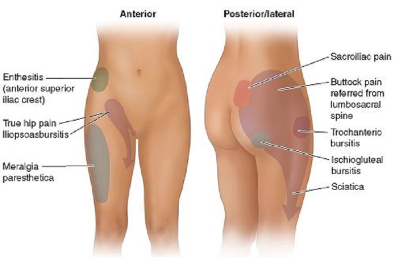 Hip Pain One Of The Discomforts That Often Occur In Pregnant Woman April 2021 Motherhood Malaysia