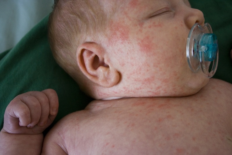 The Common Skin Conditions In Newborns