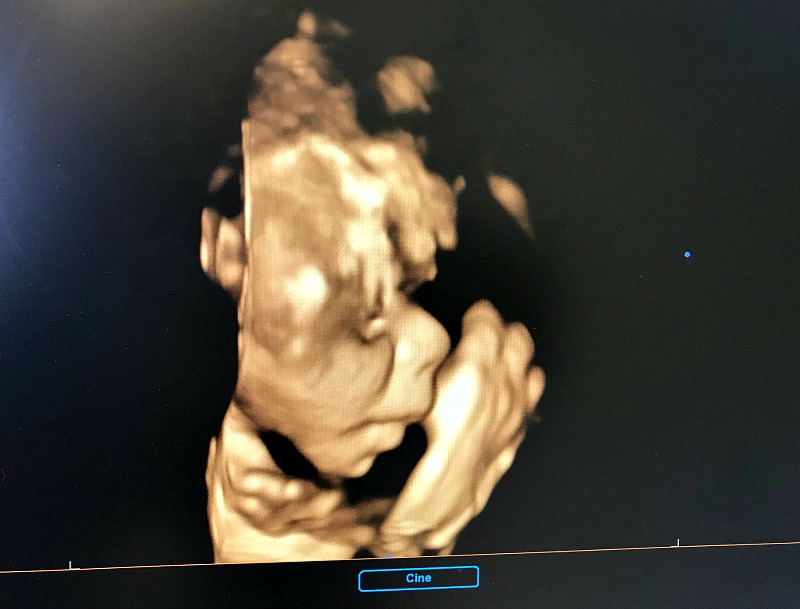 Here is the photo of the detailed scan of baby peanut.