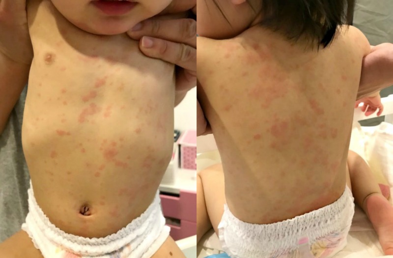 Little Andrea’s rashes front and back by the second day (Image Credit: Alison Tham)