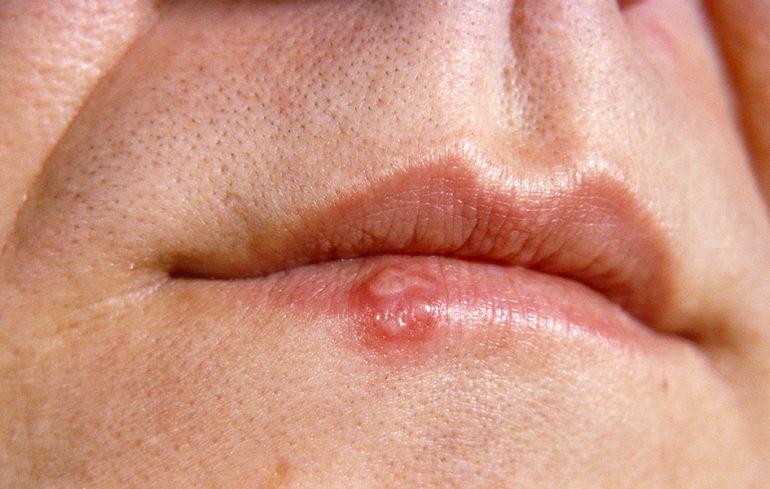 cold-sore-rash