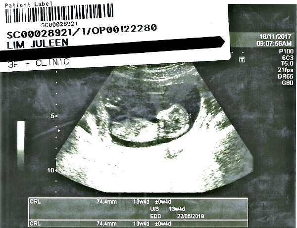 One of the earlier ultrasound scans of Sher Yi.