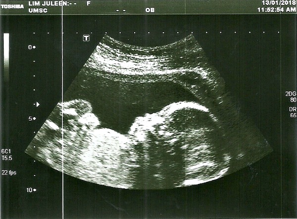 Here is the ultrasound scan of Sher Yi done at UMSC.