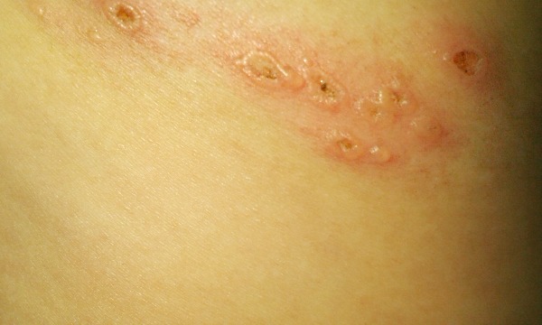 The blistery, itchy, snake-like Shingles on my back.