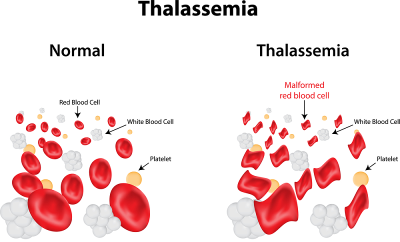 Thalassaemia in children