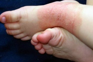 Eczema on the feet of a child (Image Credit: footpainexplored.com) Malaysia