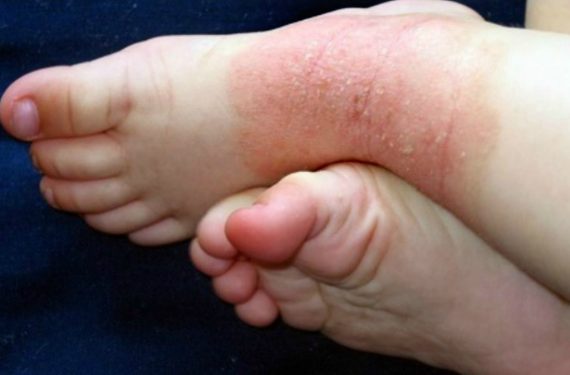 Eczema on the feet of a child (Image Credit: footpainexplored.com) Malaysia
