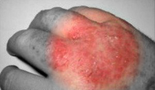 This is Staph Infection. Many people with atopic dermatitis also develop these secondary infections. (Image Credit: millbasindoctor) 