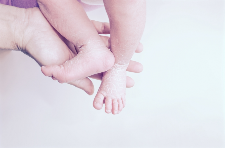 baby dry skin