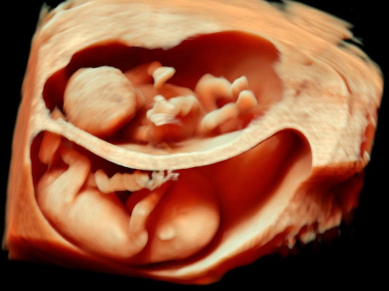 3D Ultrasound of DiDi twins at 12 weeks. They each have their own space and do not risk umbilical cord entanglement. DiDi twins are usually Fraternal although some Identical twins that split early may also be DiDi (Image Credit: termedia.pl)