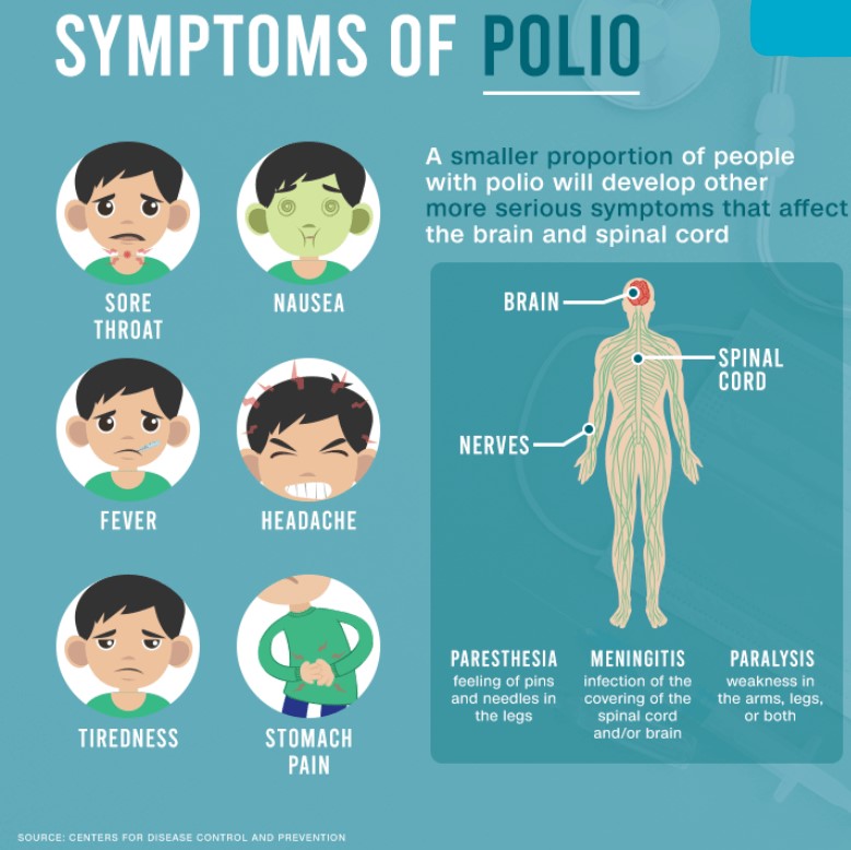 poliovirus symptoms