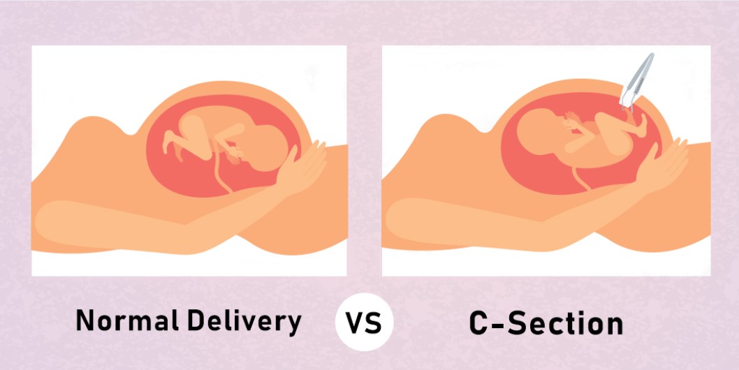 normal delivery vs c-section for late pregnancy