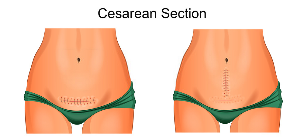 Csection for late pregnancy 