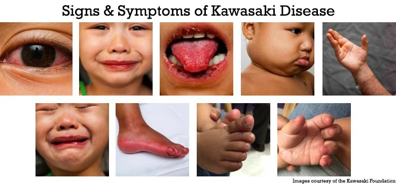 signs of kawasaki