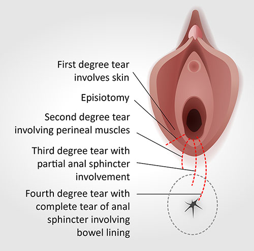 grades of perineal tear