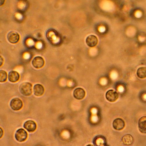 These are white blood cells seen under a microscope from a urine sample. Many reports have said that uncircumcised infants and children are more susceptible to UTI than those circumcised. UTI is an infection that affects part of the urinary tract. When it affects the lower urinary tract it is known as a bladder infection (cystitis) and when it affects the upper urinary tract it is known as a kidney infection (pyelonephritis) (Image Credit: Commons.wikimedia.org/wiki/File: Pyuria). 