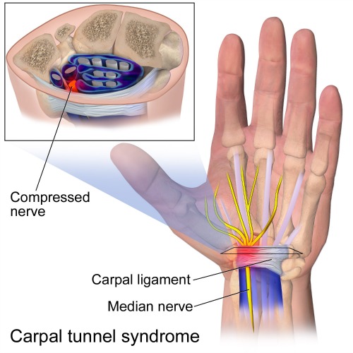 Anatomy of the carpal tunnel, showing the median nerve passing through the tight space it shares with the finger tendons (Image Credit:BruceBlaus/Medical gallery of Blausen Medical 2014/wikimediacommons CC BY 3.0) 