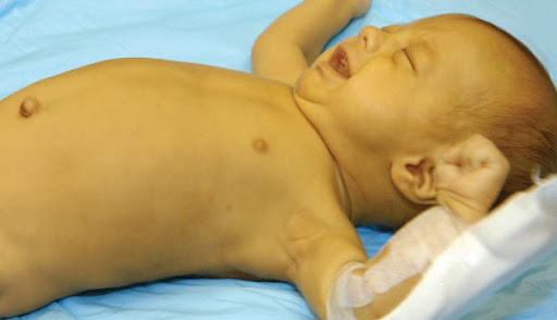 a breastfeeding jaundice baby