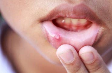 ulcer on children's lip