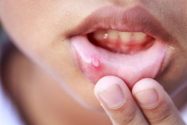 ulcer on children's lip