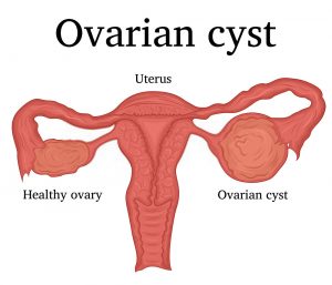 ovarian cyst illustration