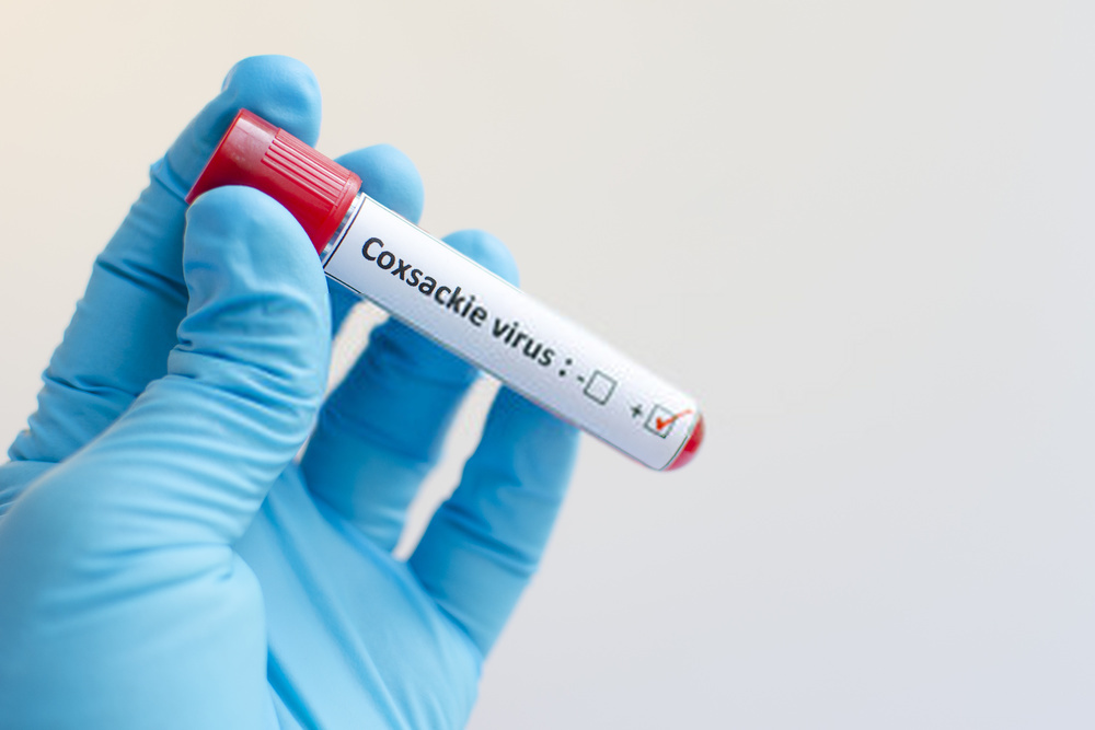blood sample with coxsackie virus
