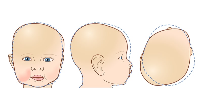 types of flat head syndrome