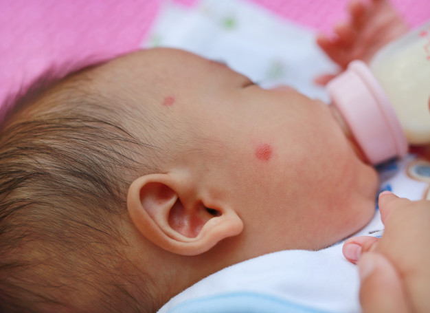mosquito bites on a baby's cheeks