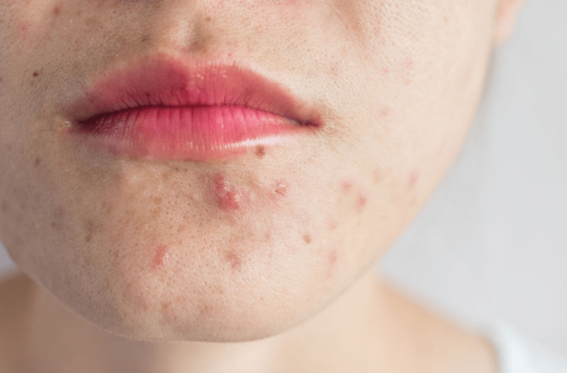 "Urgh, get it off my face!" The Proper Ways to Treat Your Pregnancy Acne