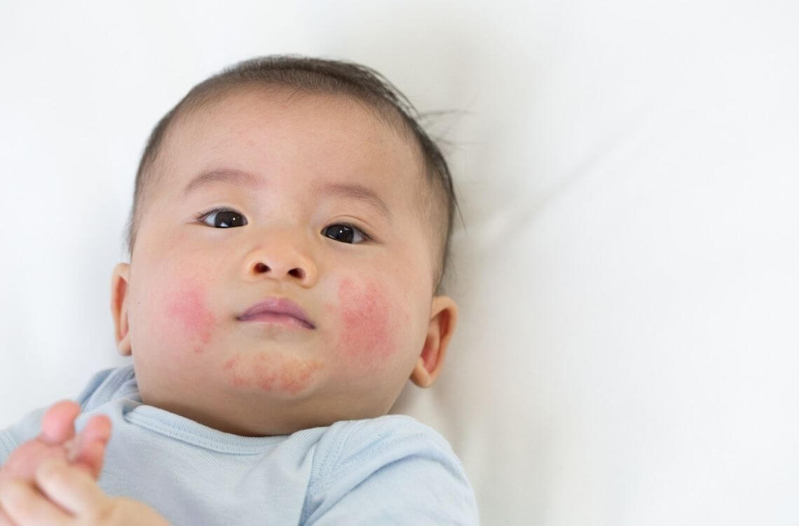 rashes are among the children's skin conditions that often happen 