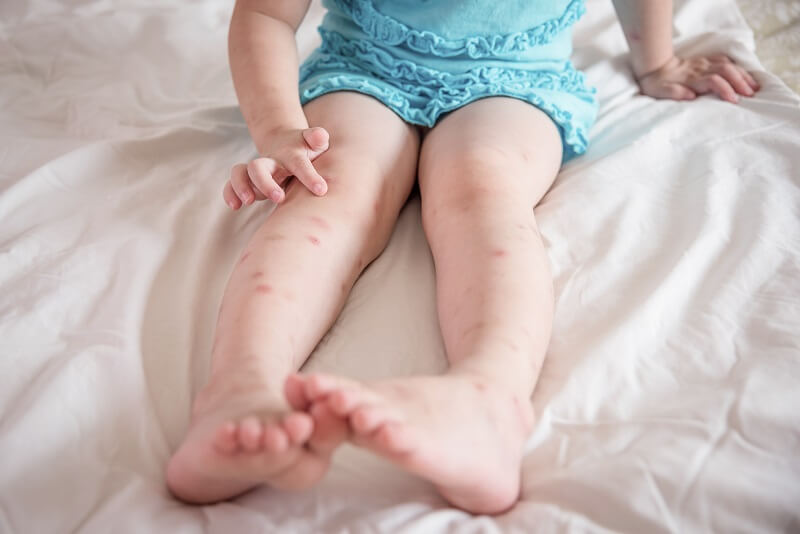 little girl legs with mosquito bites