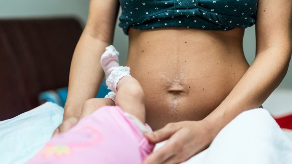 Stretch marks after your delivery is common to have for your postpartum body 