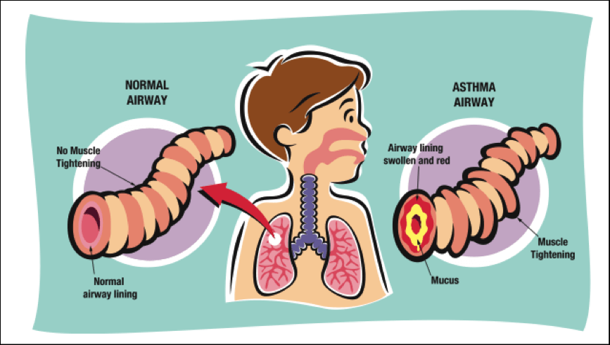 normal vs asthma in children airway