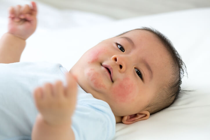 baby with rashes, one of the food allergies