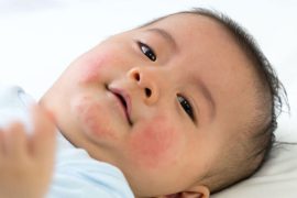 baby-eczema