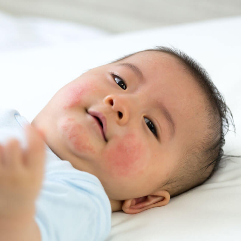 baby-eczema