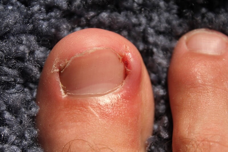 ingrown toenails - foot conditions in kids