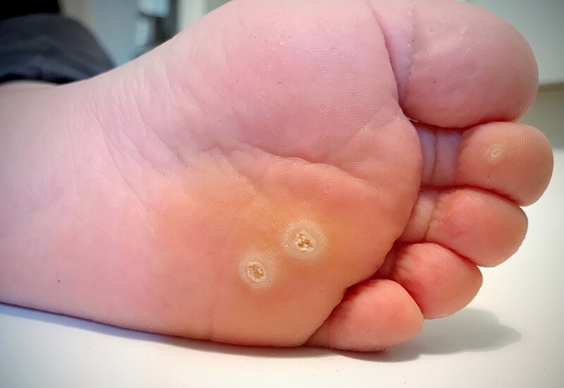 viral warts - foot conditions in kids
